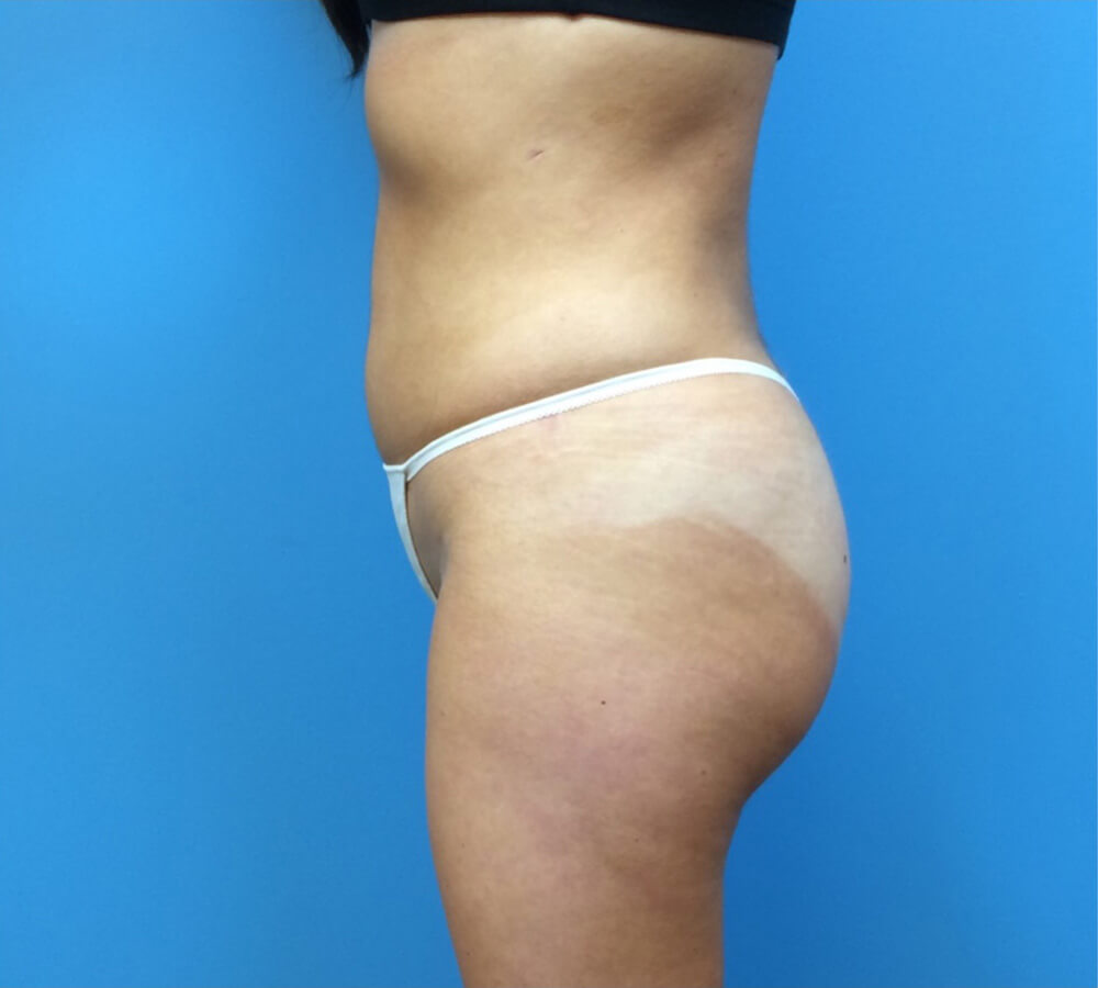 Brazilian-Butt-Lift-Case--265 | After Brazilian Butt Lift 1