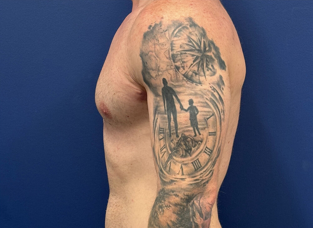 Gynecomastia-Case--28230 | After Gynecomastia / Male Breast Reduction 3