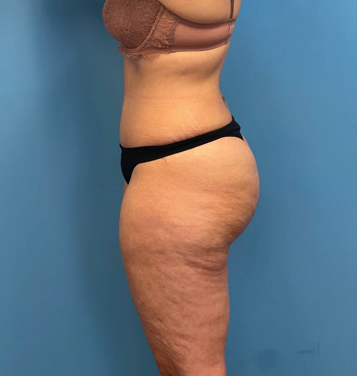 Lipoabdominoplasty-Case--25555 | After Liposuction 2