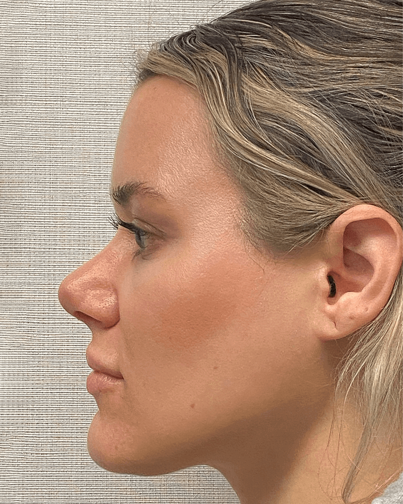 Rhinoplasty-Case--23703 | After Rhinoplasty 3