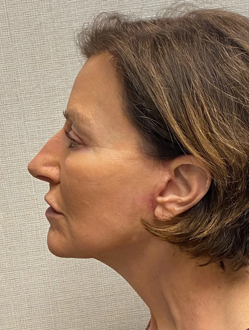 Case--9966 | After Facelift 2