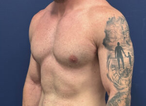 Gynecomastia-Case--28230 | After Dr. Samir Rao 2