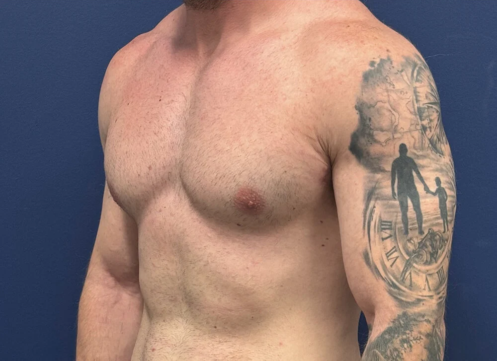 Gynecomastia-Case--28230 | After Gynecomastia / Male Breast Reduction 2