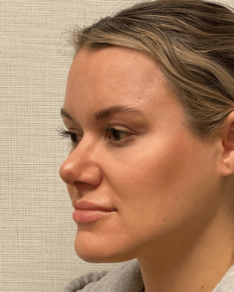 Rhinoplasty-Case--23703 | After Rhinoplasty 4