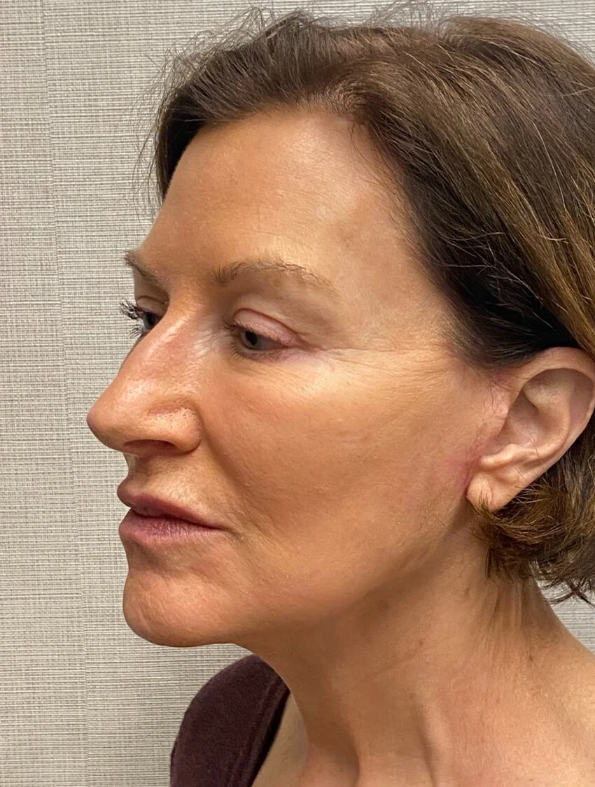 Case--9966 | After Facelift 3