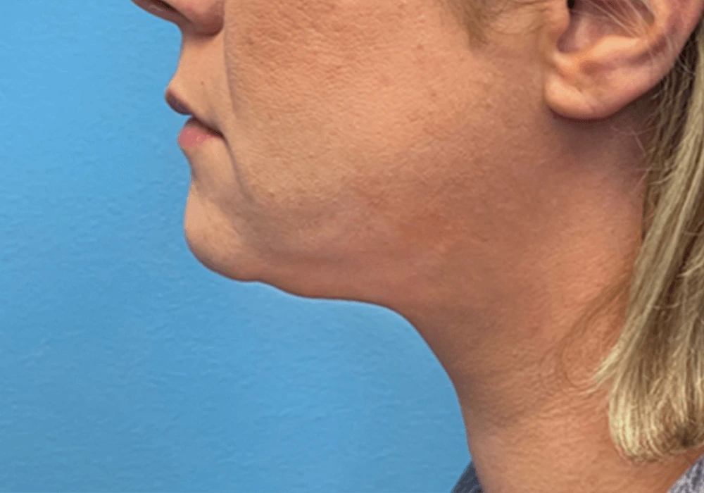 Case--20811 | After Submental Liposuction 1