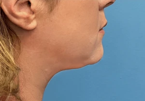 Case--20811 | After Submental Liposuction 2