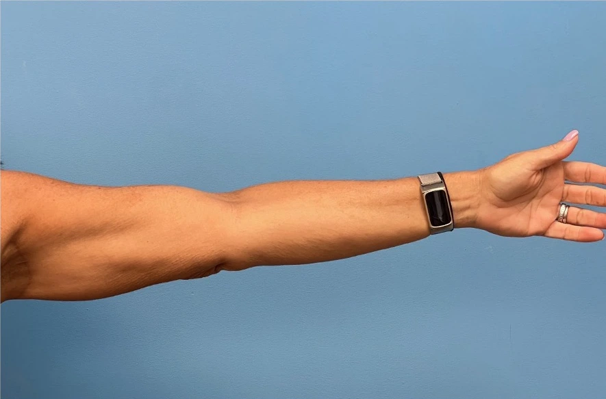 Left arm profile of patient after undergoing brachioplasty procedure