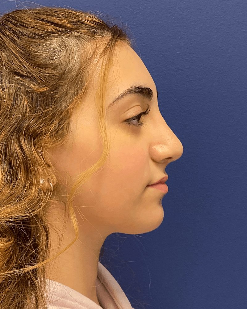 Rhinoplasty-Case--23921 | After Rhinoplasty 5