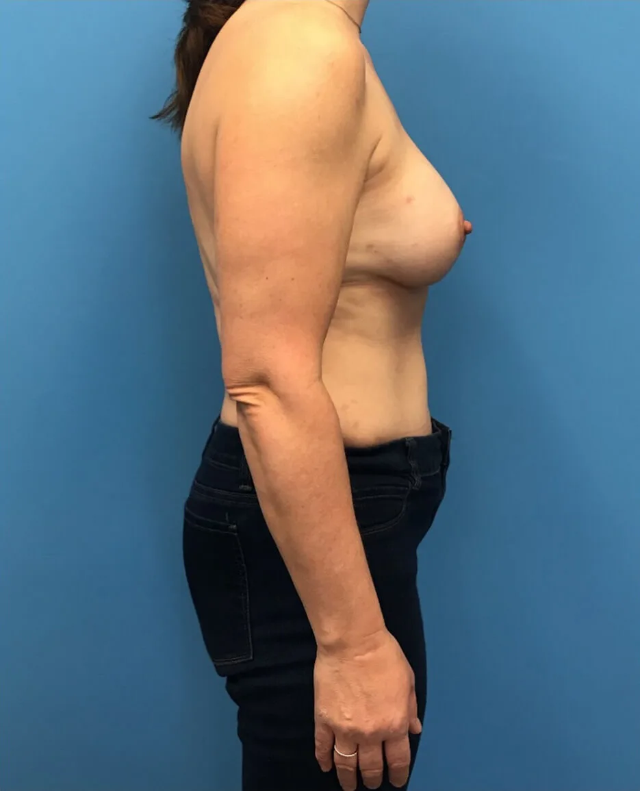 DIEP-Flap-Case--139 | After DIEP Flap 2