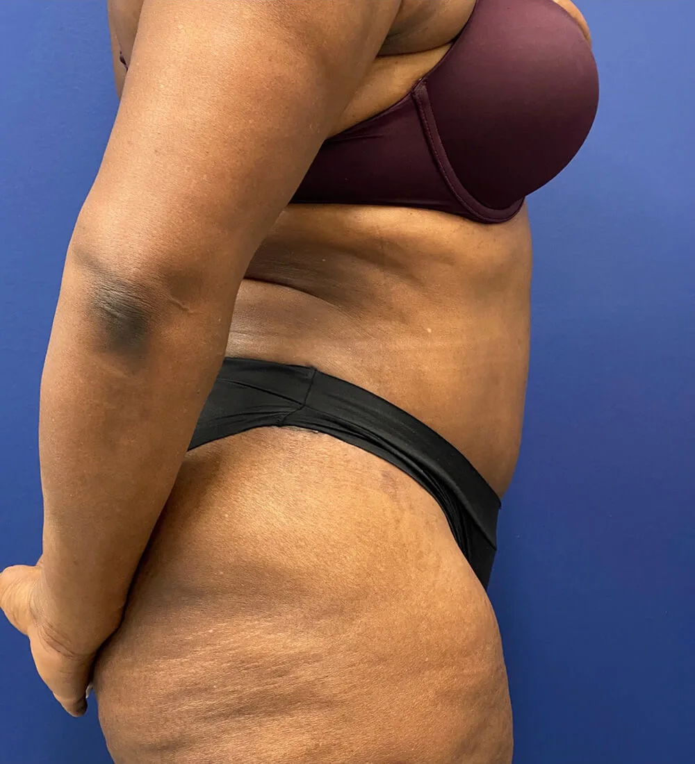 Lipoabdominoplasty-Case--24124 | After Tummy Tuck 5