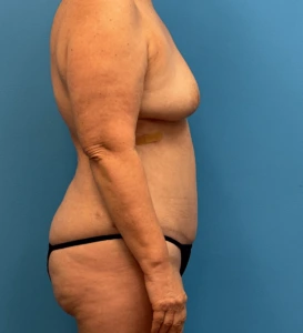 Lipoabdominoplasty-Case--24903 | After Tummy Tuck 2