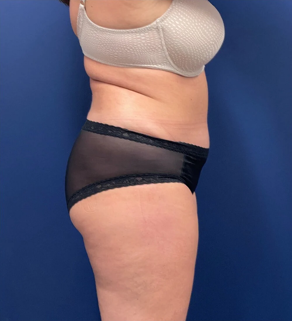 Lipoabdominoplasty-Case--24903 | After Tummy Tuck 2