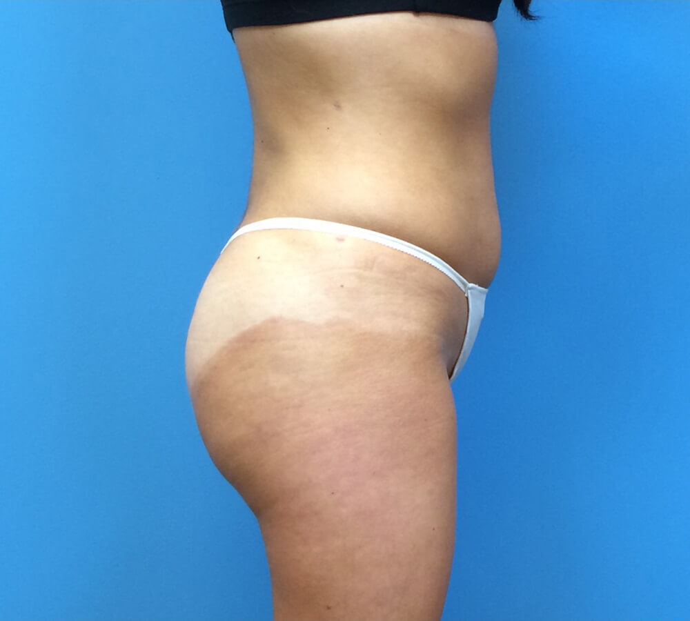 Brazilian-Butt-Lift-Case--265 | After Brazilian Butt Lift 3