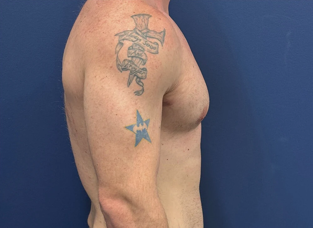 Gynecomastia-Case--28230 | After Gynecomastia / Male Breast Reduction 5