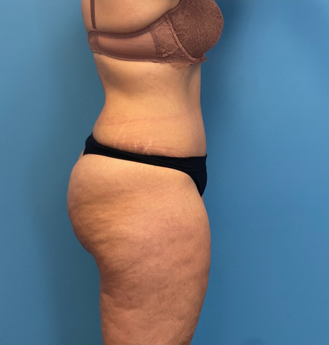 Lipoabdominoplasty-Case--25555 | After Liposuction 3