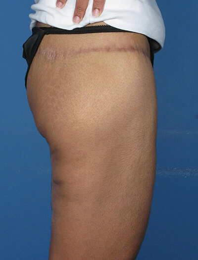 Thigh-lift-Case--75 | After Thigh Lift 4