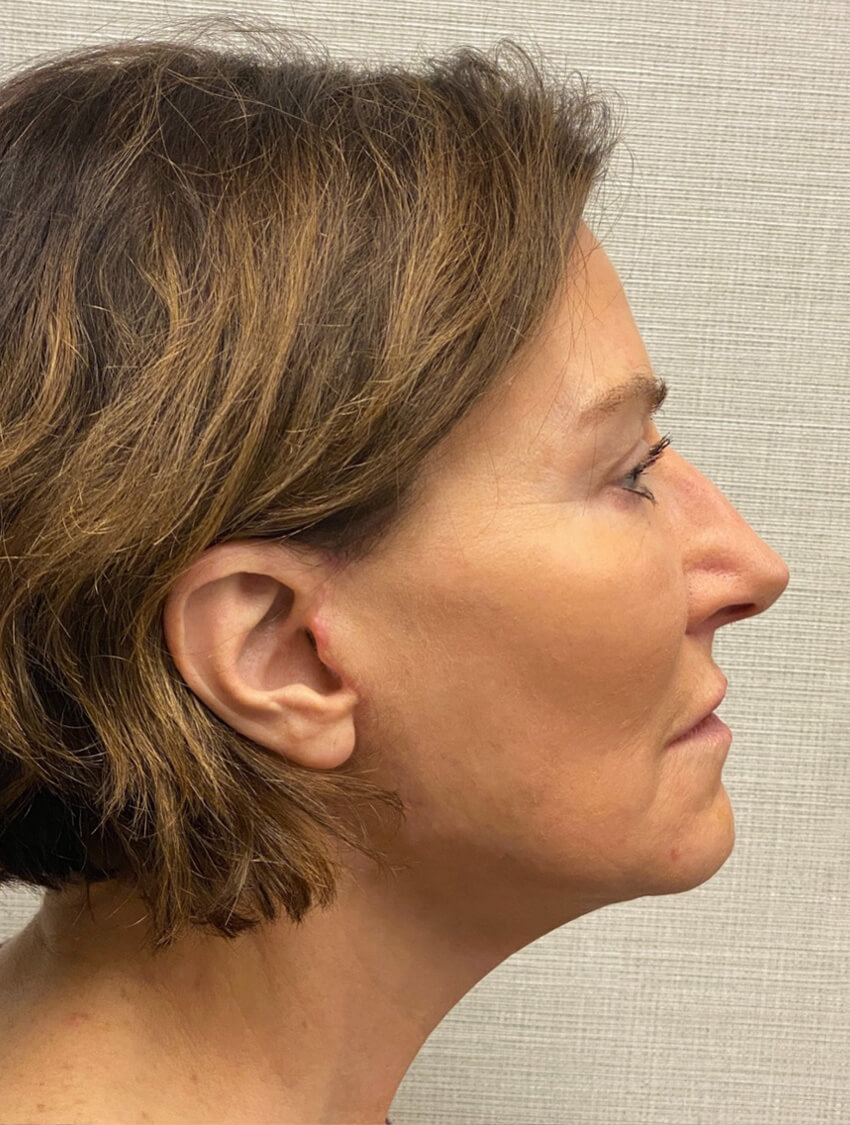 Case--9966 | After Facelift 5