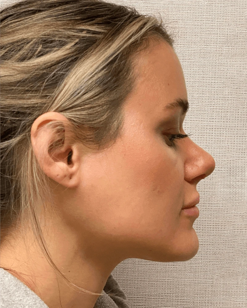 Rhinoplasty-Case--23703 | After Rhinoplasty 5