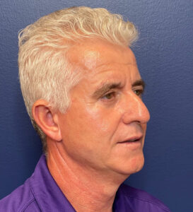 Facelift-Blepharoplasty-Case--291 | After Dr. Samir Rao 2