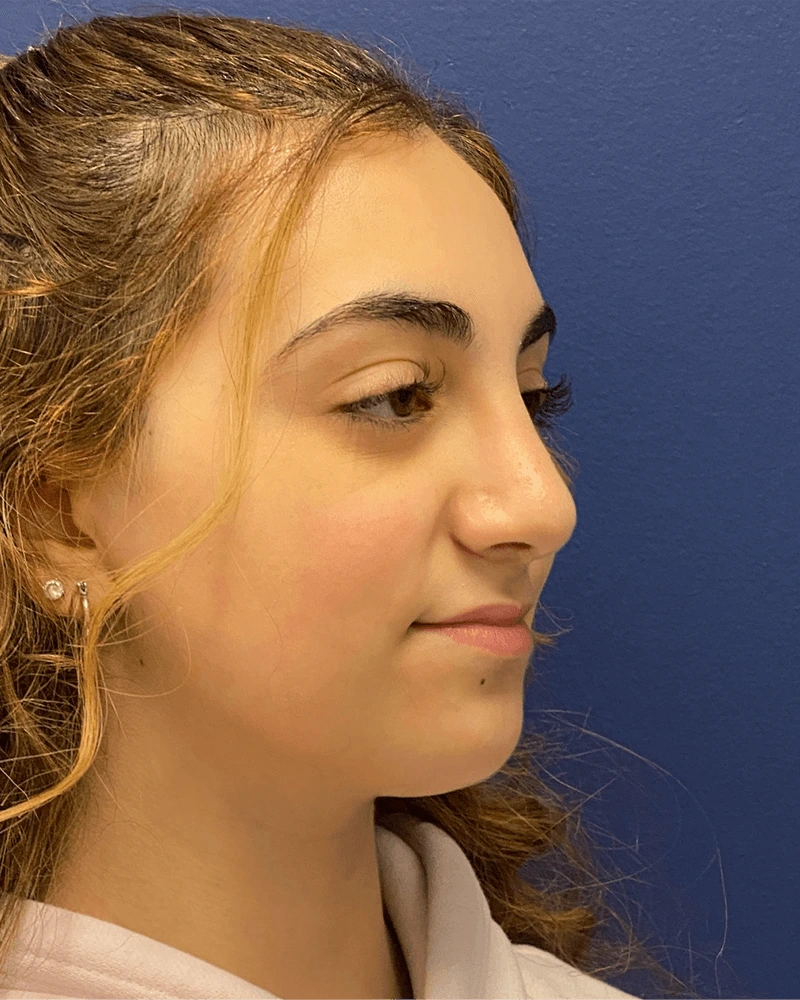 Rhinoplasty-Case--23921 | After Rhinoplasty 4