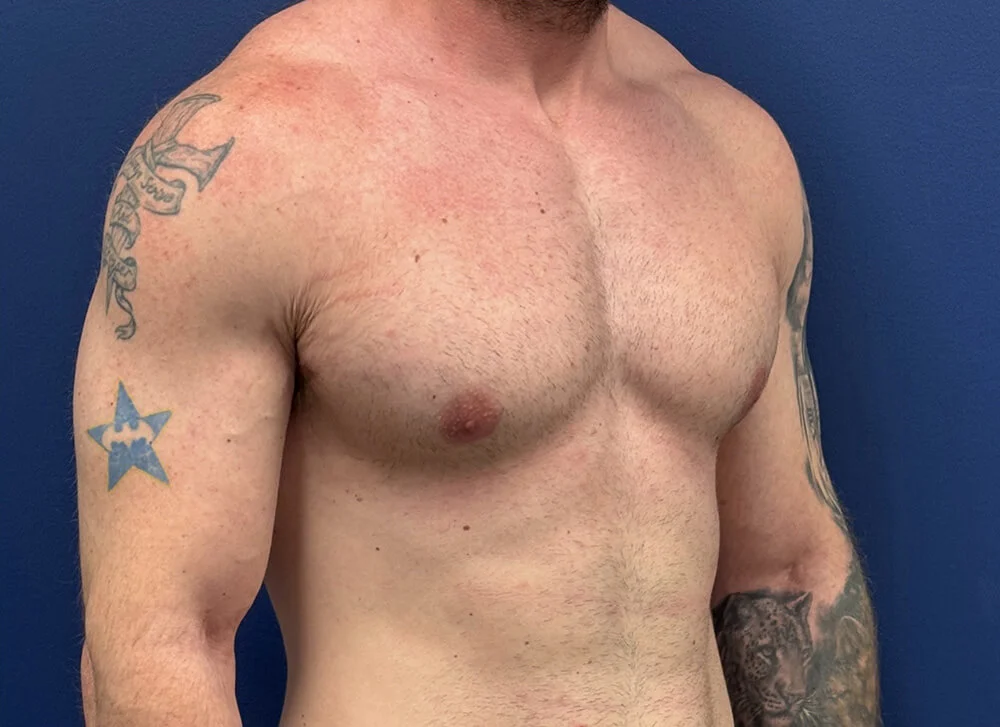 Gynecomastia-Case--28230 | After Gynecomastia / Male Breast Reduction 4