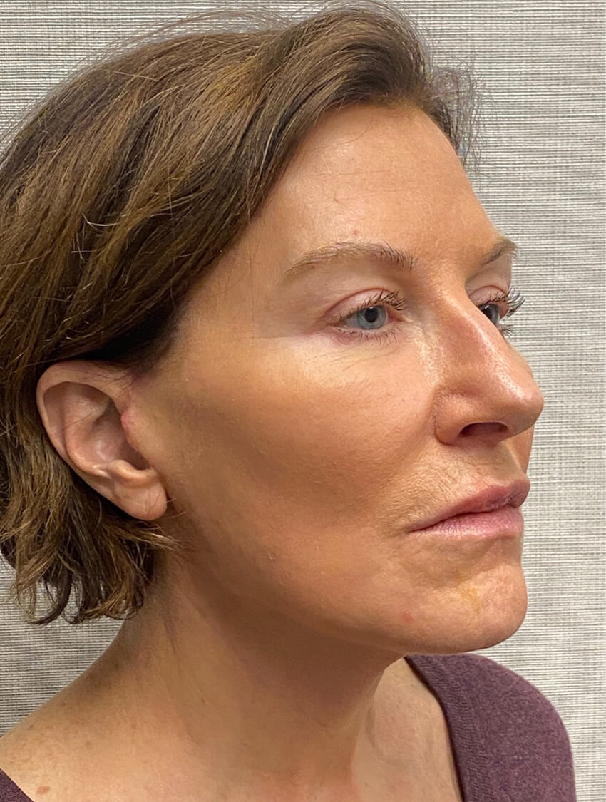 Case--9966 | After Facelift 4