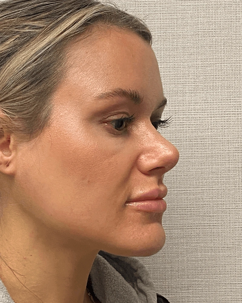 Rhinoplasty-Case--23703 | After Rhinoplasty 6