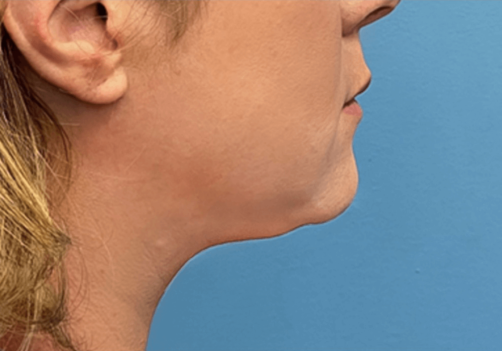 Case--20811 | After Submental Liposuction 2