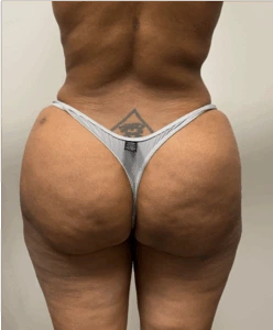 Brazilian-Butt-Lift-Case--7979 | After Brazilian Butt Lift 1