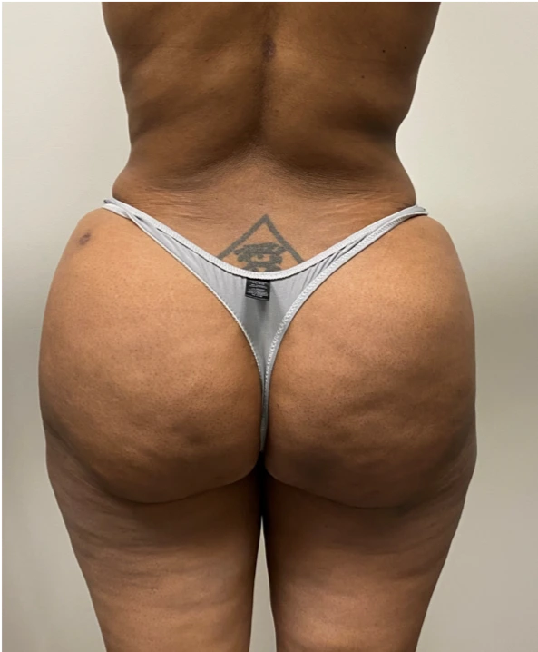 Brazilian-Butt-Lift-Case--7979 | After Brazilian Butt Lift 1