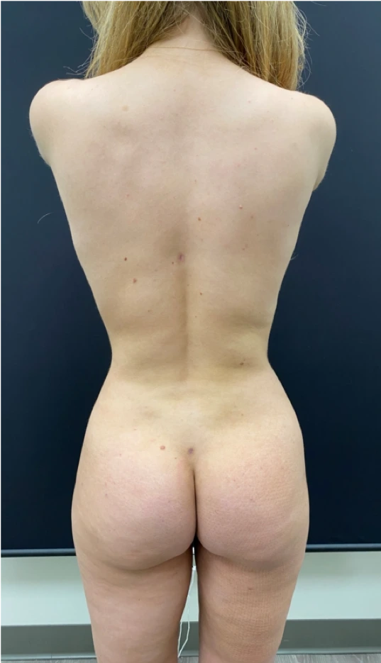 Liposuction-Case--7212 | After Liposuction 7