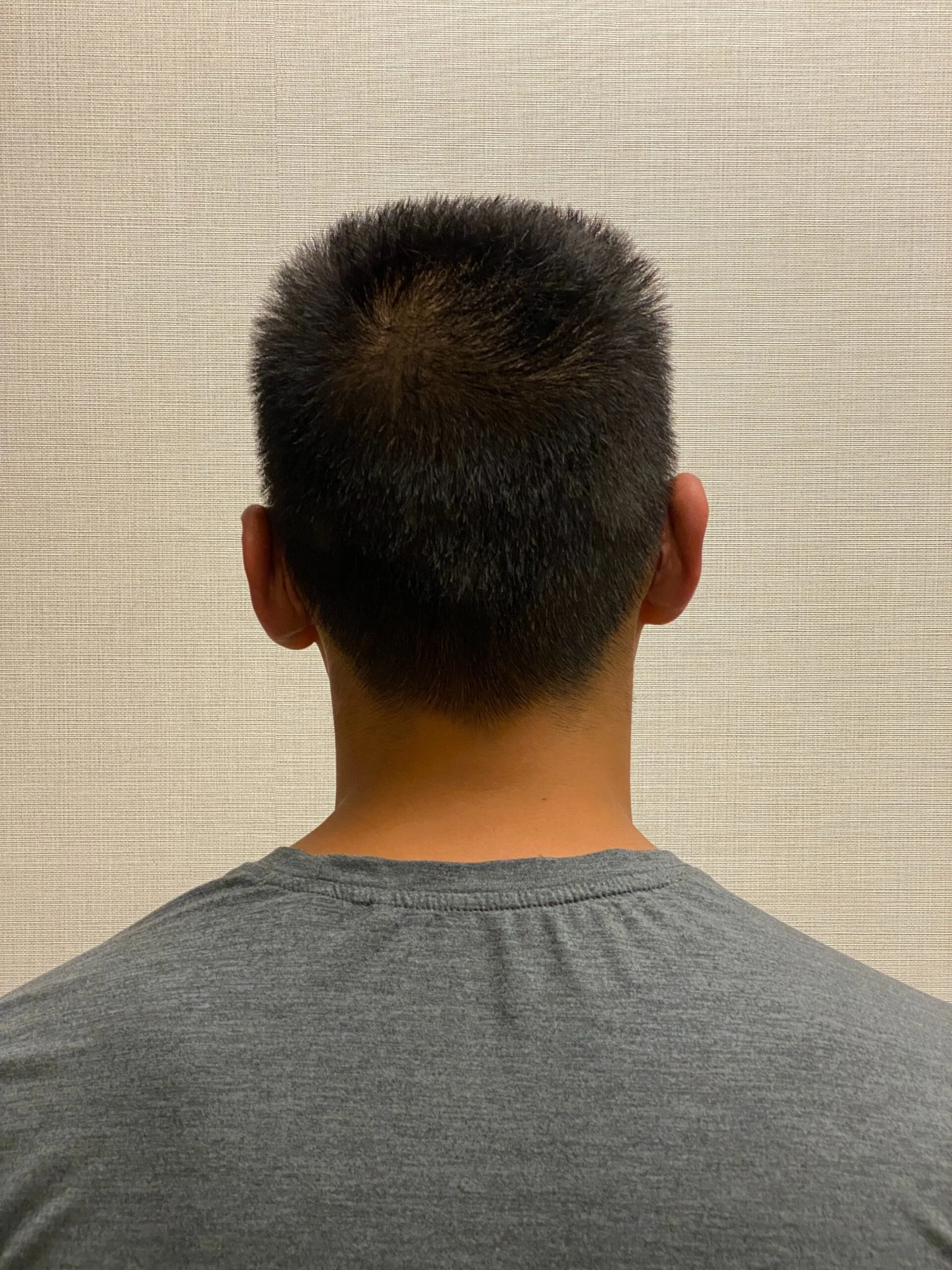 Otoplasty-Case--2681 | After Otoplasty 6