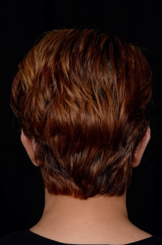 Otoplasty-Case--4655 | After Otoplasty 5