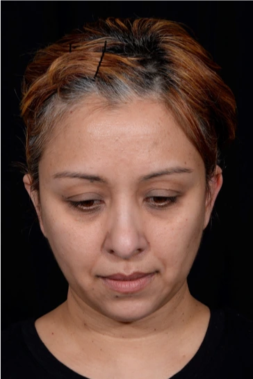 Otoplasty-Case--4655 | After Otoplasty 4