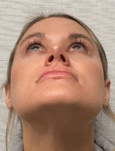 Rhinoplasty-Case--4972 | After Dr. Arjun Kanuri 2