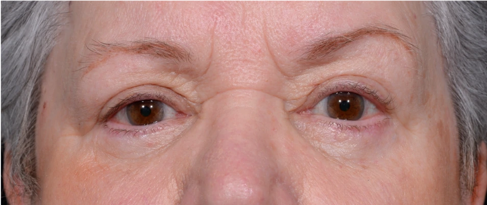 Blepharoplasty-Case--6005 | After Eyelid Surgery 1
