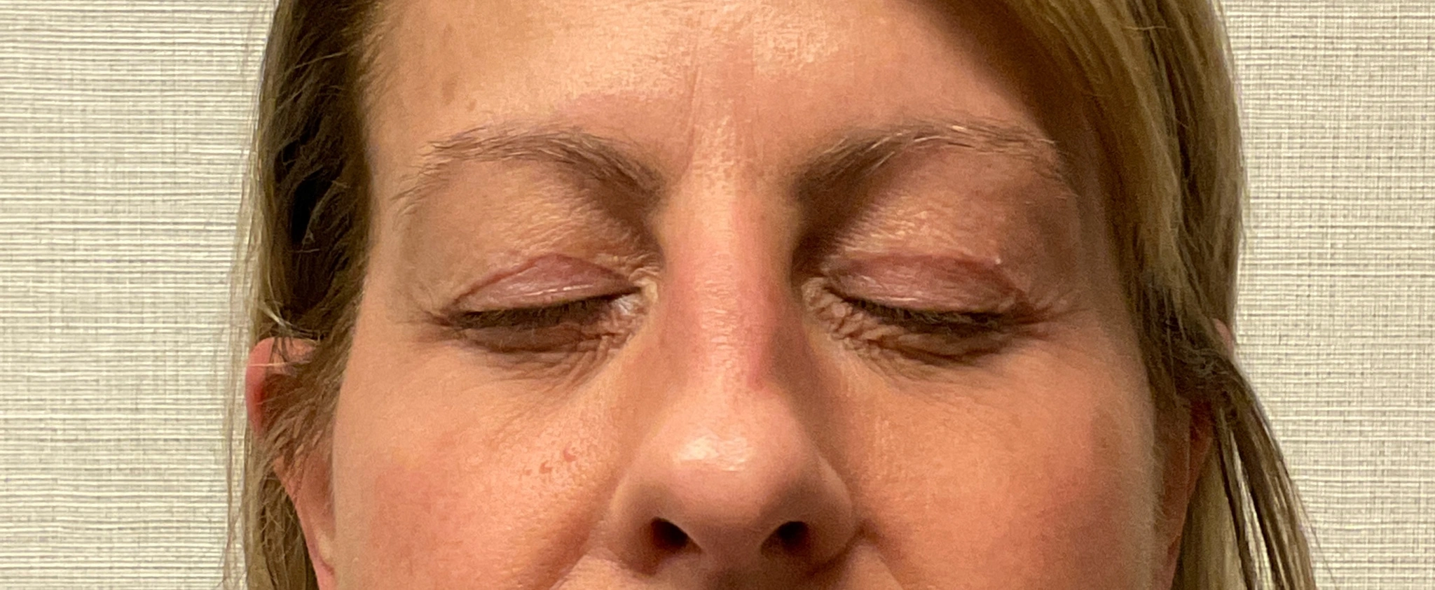 Upper-Blepharoplasty-Case--7202 | Before Eyelid Surgery 2