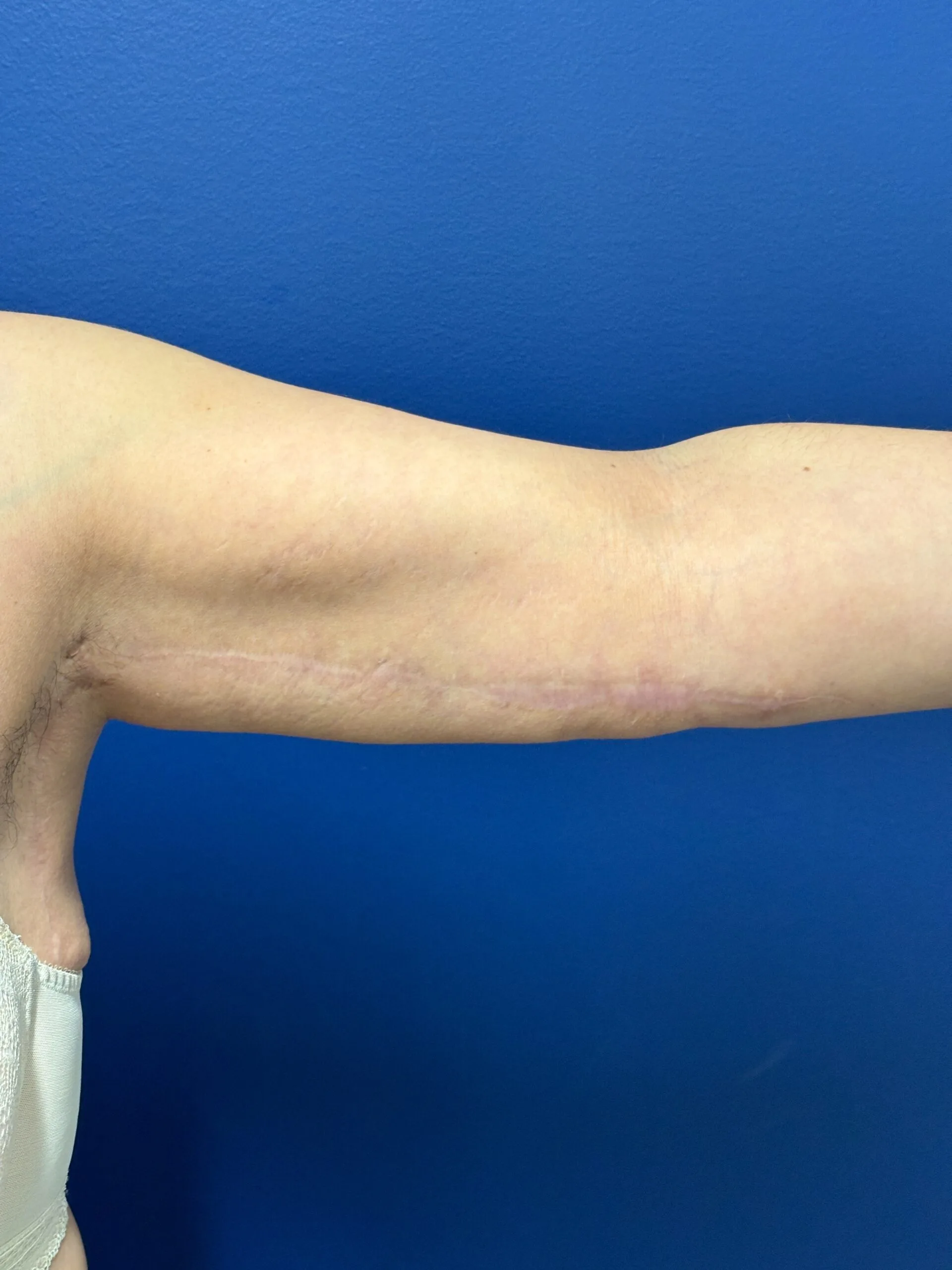 Brachioplasty-Case--1162 | After Arm Lift 1