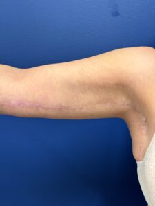 Brachioplasty-Case--1162 | After Arm Lift 2