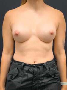 Breast-Augmentation-Case--2225 | After Breast Augmentation 1