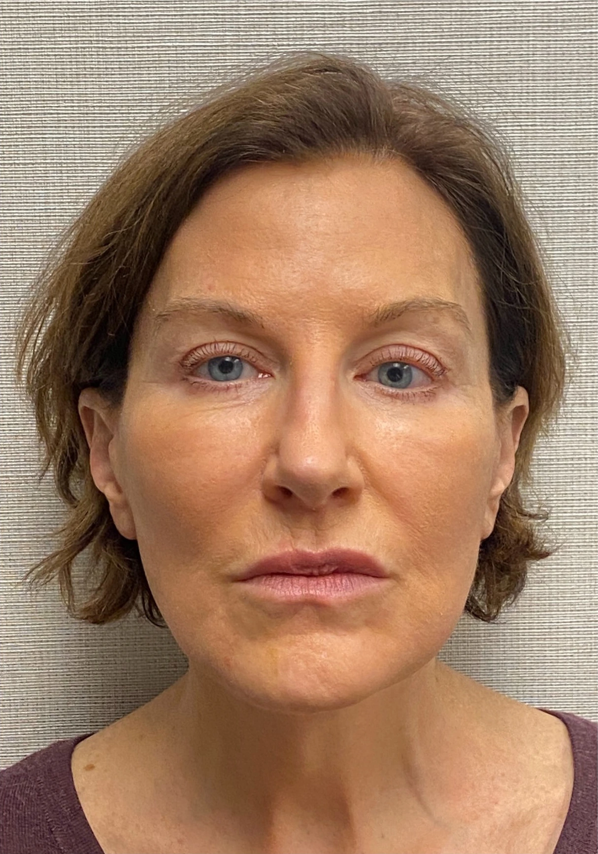 Facelift-Case--6591 | After Facelift 1