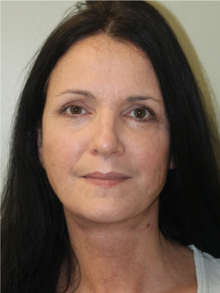 Face-and-Neck-Lift-Case--9403 | After Facelift 1