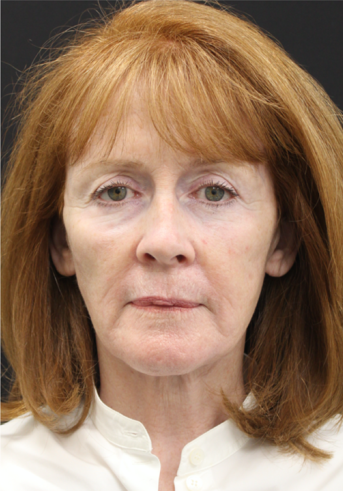 Necklift-Case--5698 | After Neck Lift 1