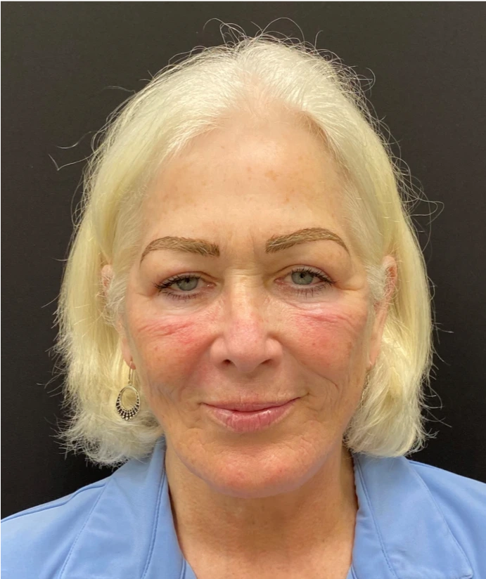 Facelift-Case--8874 | After Facelift 1