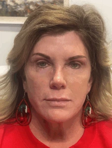 Facelift-Case--8163 | After Face360 1