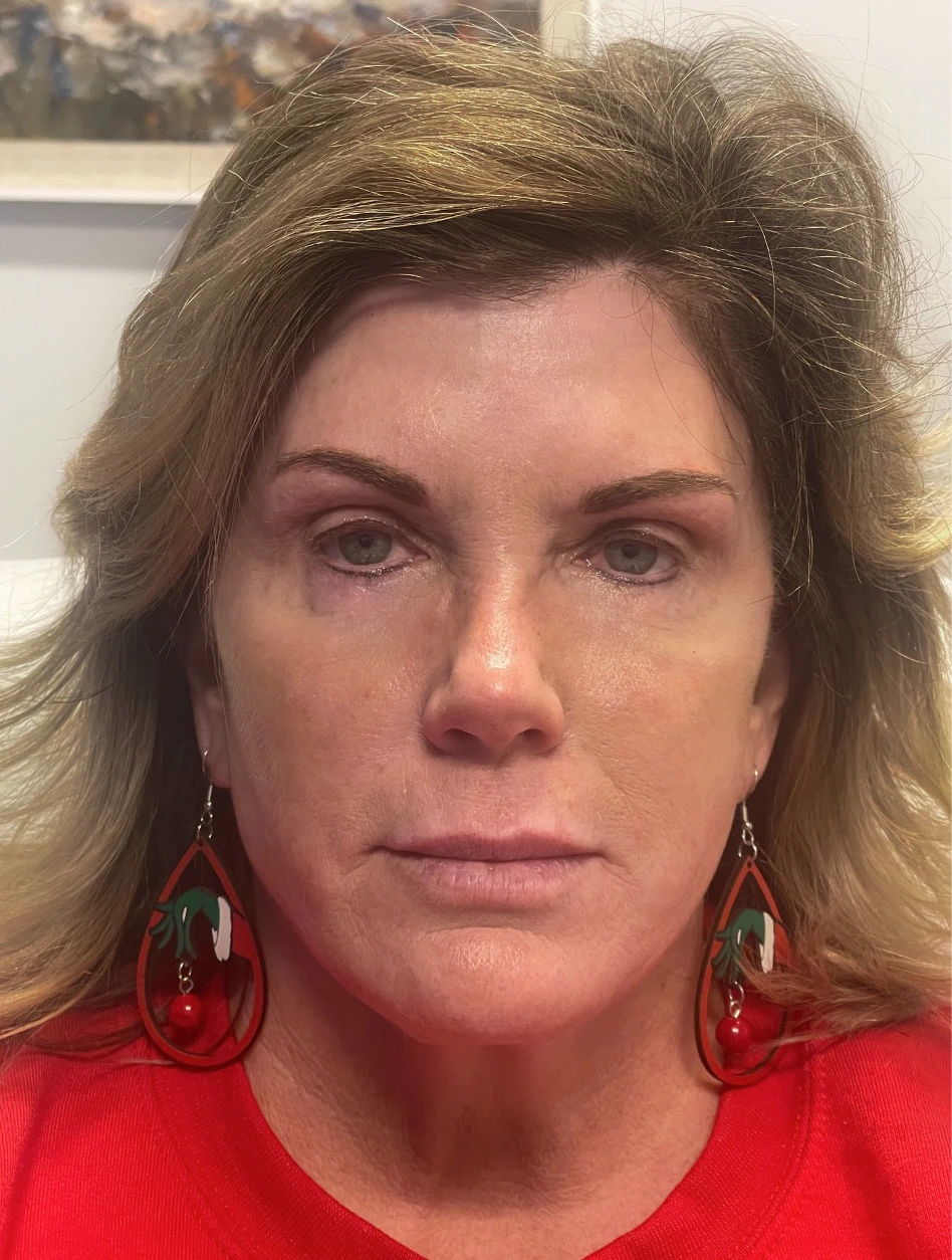 Facelift-Case--8163 | After Face360 1