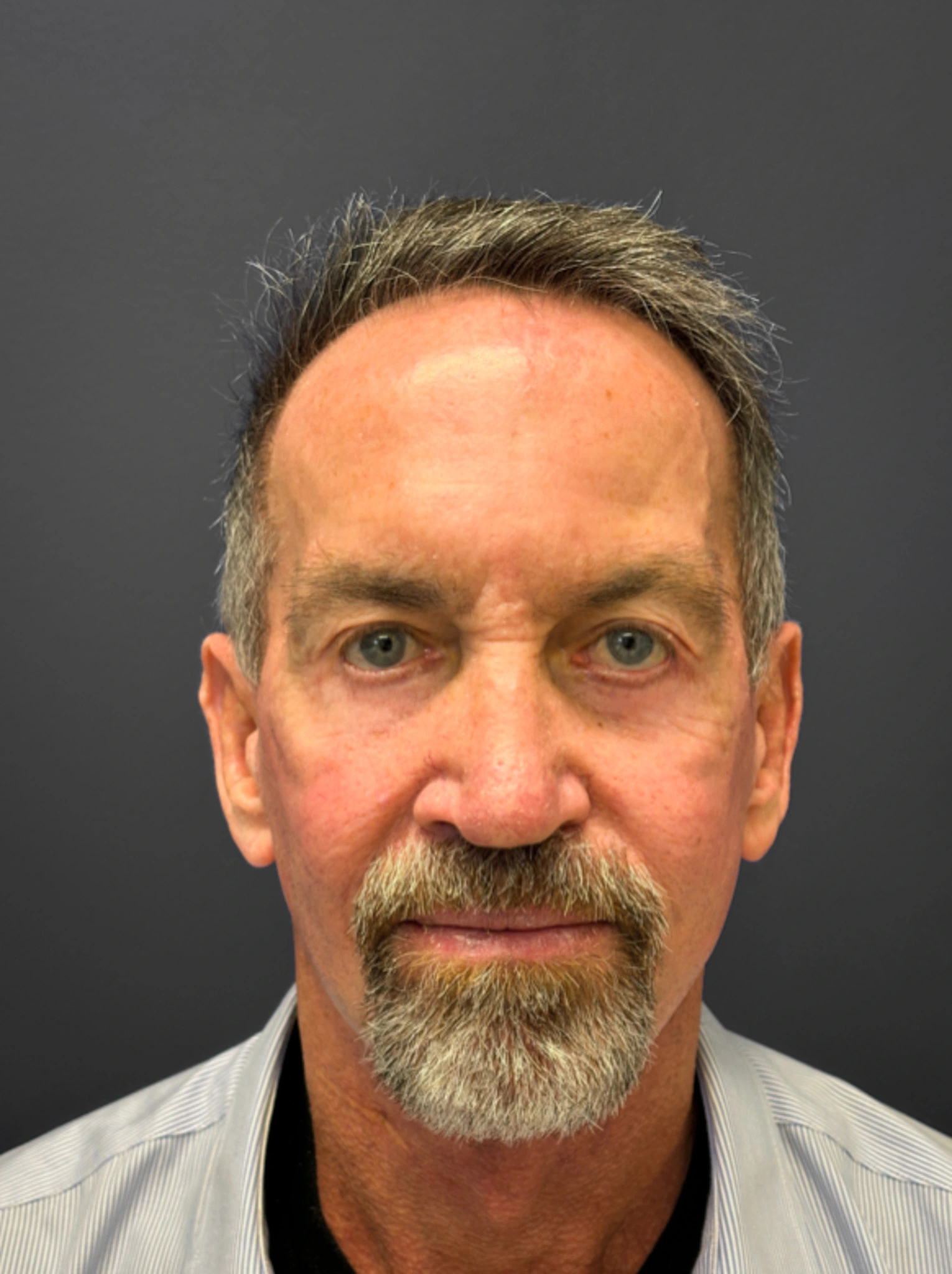 After Facelift, Rhinoplasty, Blepharoplasty (Front)