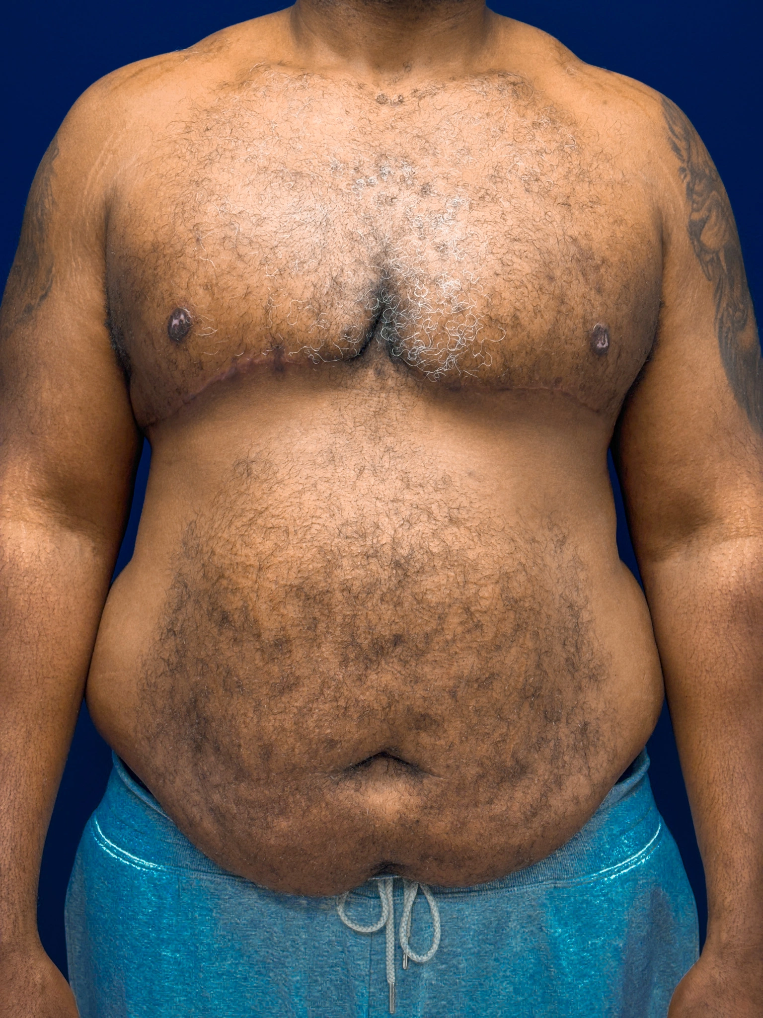 Gynecomastia-Case--4473 | After Gynecomastia / Male Breast Reduction 1