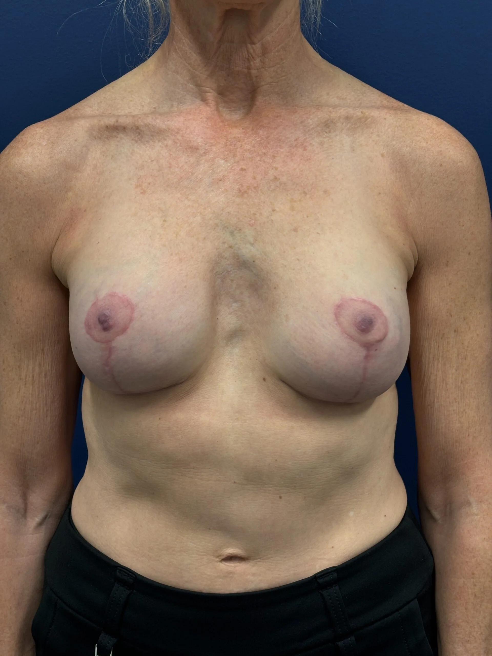 Revision-Breast-Augmentation-Case--9027 | After Revision Augmentation 1